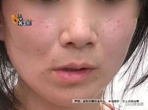 一颗痣 80,点了 110 颗!女子想叫老公来评理,结果…