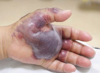 71 岁寿司食客吃生鱼感染细菌，一条手臂被截肢