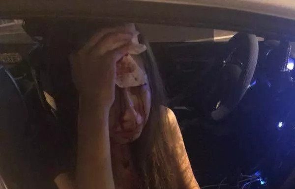 又是滴滴!25 岁女模特坐快车惨被毁容