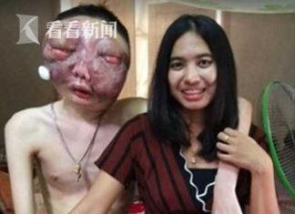 男子患癌整张脸变形模样恐怖 获女友陪伴多年离世