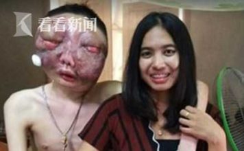 男子患癌整张脸变形模样恐怖 获女友陪伴多年离世