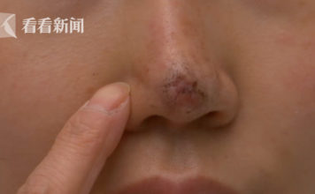 整容变毁容!女子花一万五隆鼻却致鼻头坏死 整容变毁容!女子花一万五隆鼻却致鼻头坏死