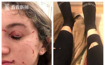 女子钻进拉杆箱 出来时把自家猫吓疯被挠花脸 女子钻进拉杆箱 出来时把自家猫吓疯被挠花脸