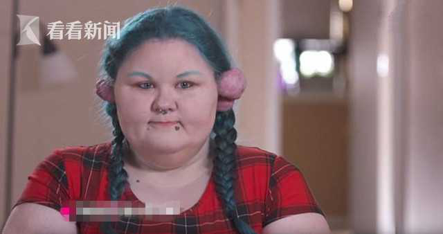 少女穿耳洞出事了 !11 年间疯长 400 克肉瘤形似怪物