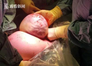 男婴出生就像外星人！疑似羊水未破就被剖腹产