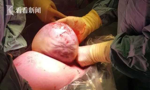 男婴出生就像外星人!疑似羊水未破就被剖腹产 男婴出生就像外星人!疑似羊水未破就被剖腹产